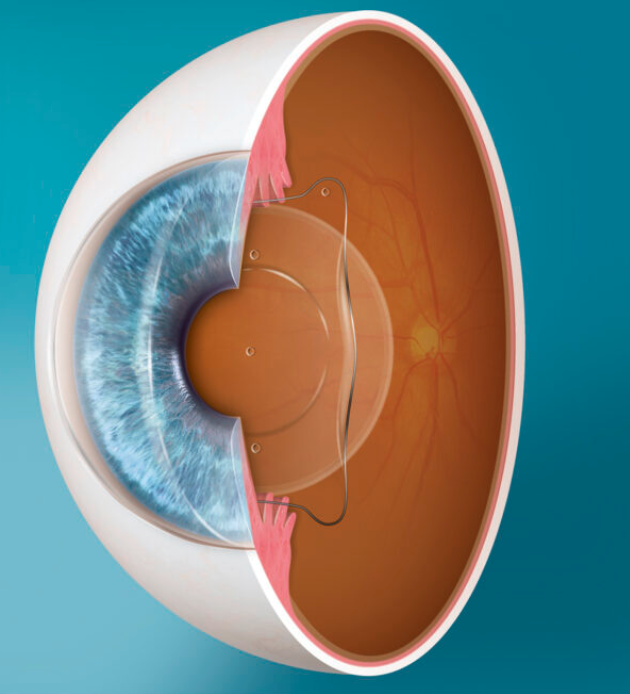 Close-up of a clear, healthy eye representing EVO ICL results